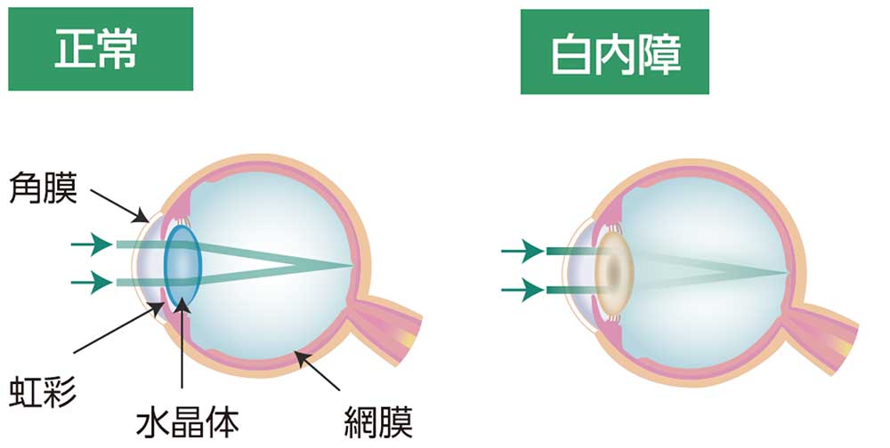 白内障とは