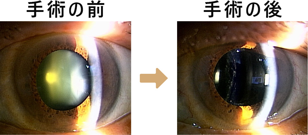白内障手術